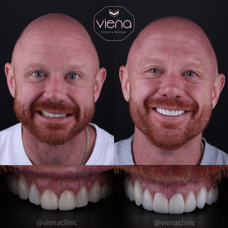 Diseño de Sonrisa en Cerámica Antes y Después
