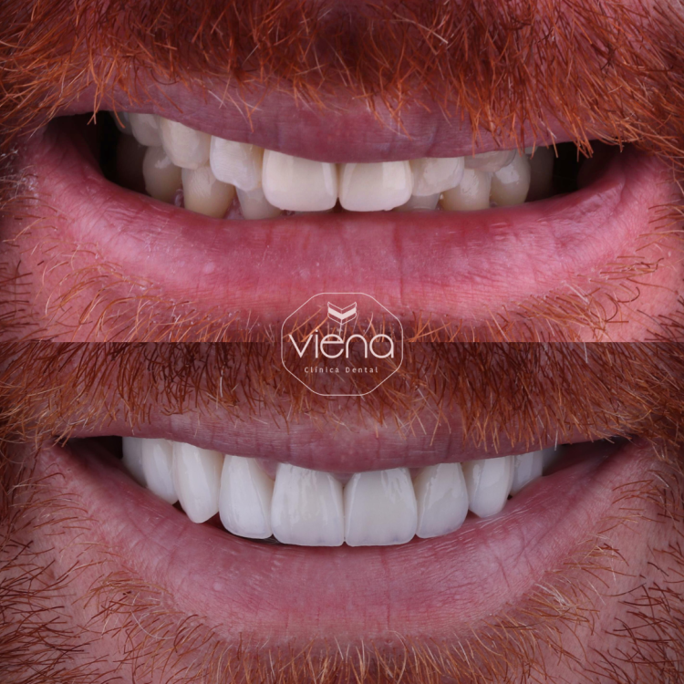 Diseño de Sonrisa Antes y Después
