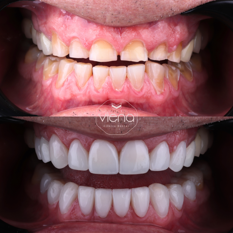 Veneers Before and After