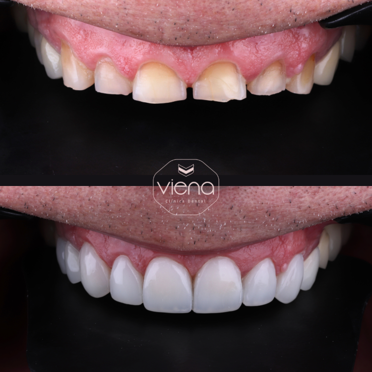 Veneers Before and After