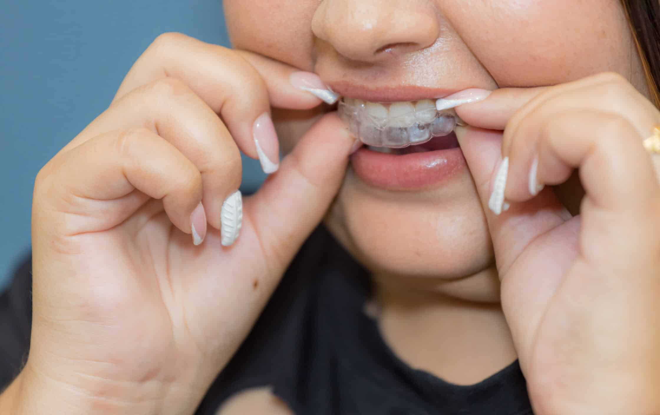 invisalign