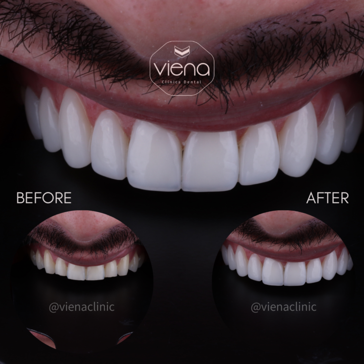 Composite veneers