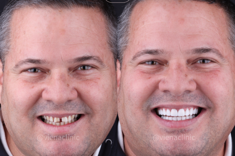 How Do Veneers Work Before and After