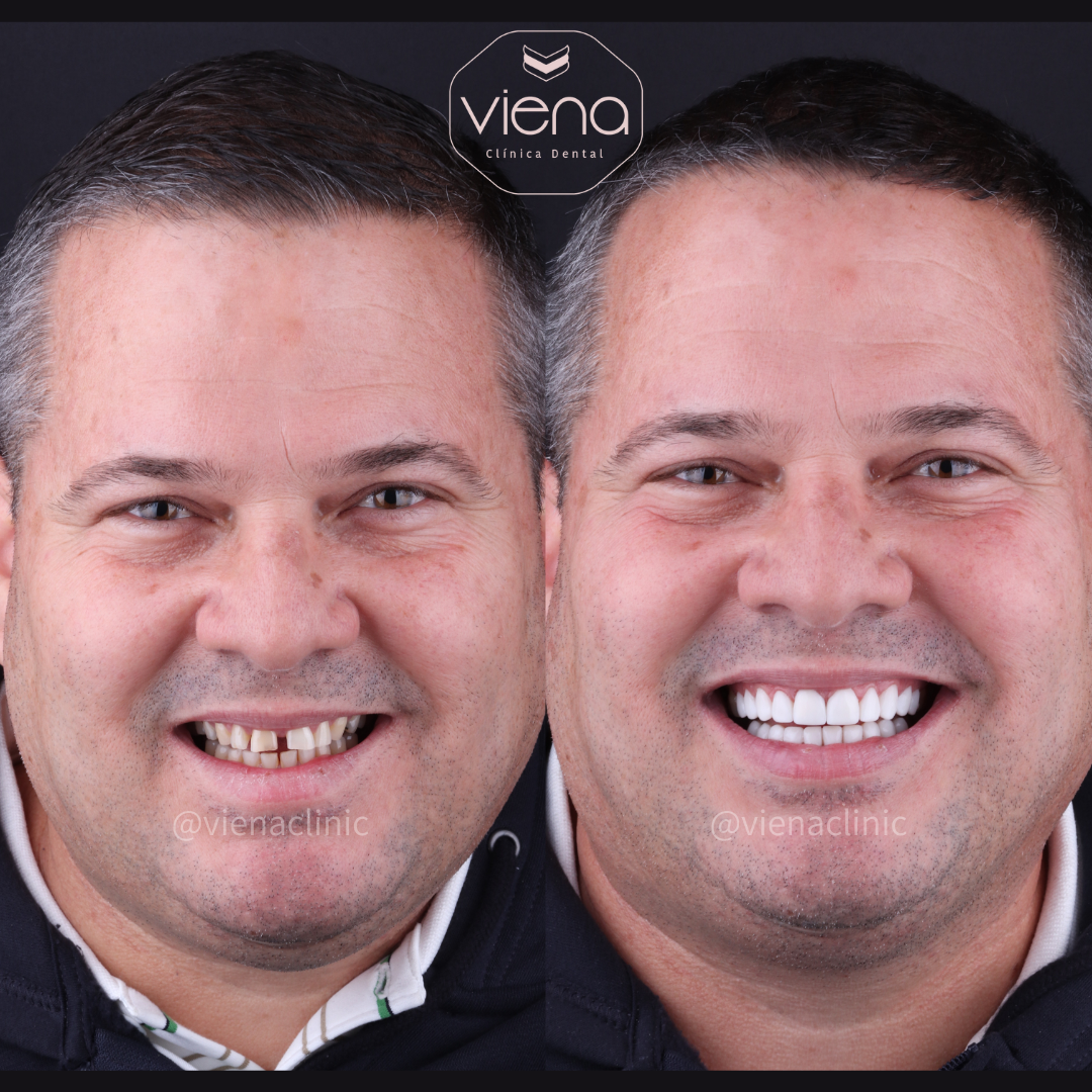 How Do Veneers Work Before and After