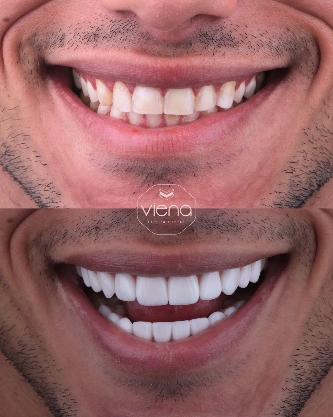 are veneers easy to break