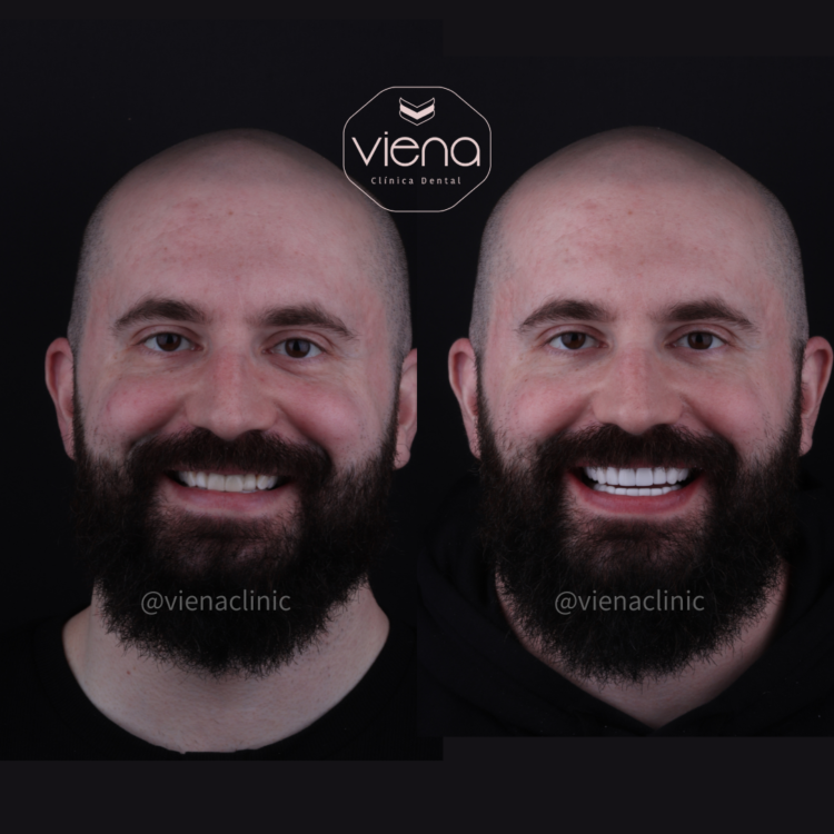 Porcelain Veneers Before and After