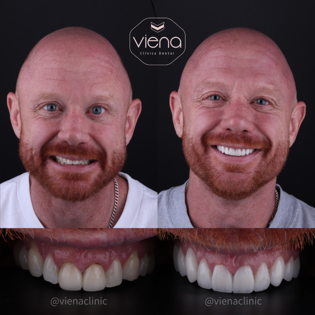 veneers vs invisalign