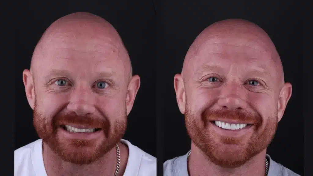 veneers in colombia
