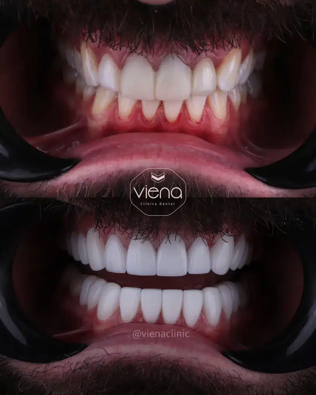 Veneers in Colombia Package