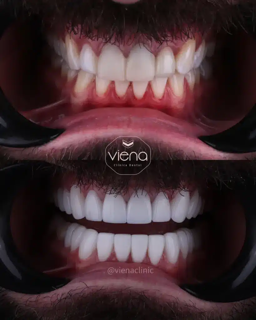 Before and after veneers in Colombia asymmetry