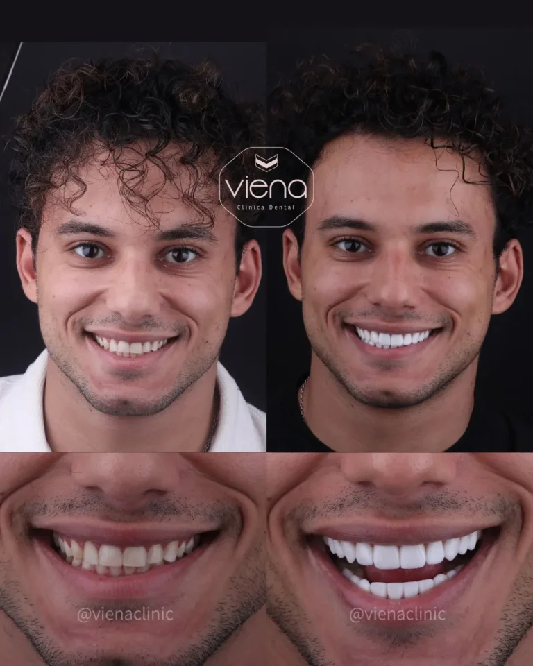Dental Clinic What Are Dental Veneers?