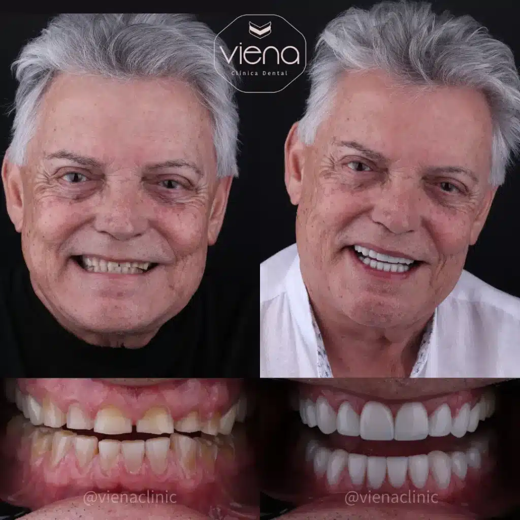 diseño de sonrisa en resina