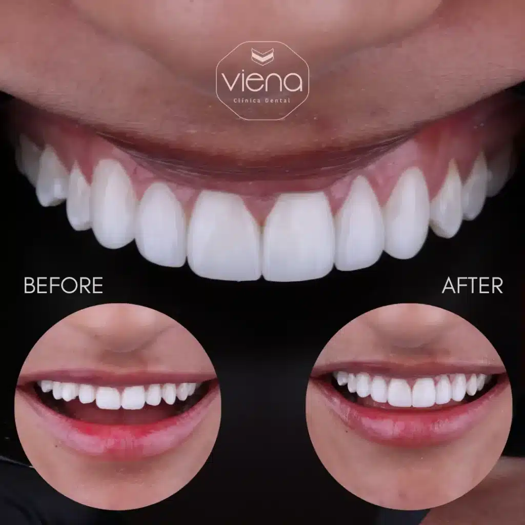 Young adult treated with veneers in Colombia