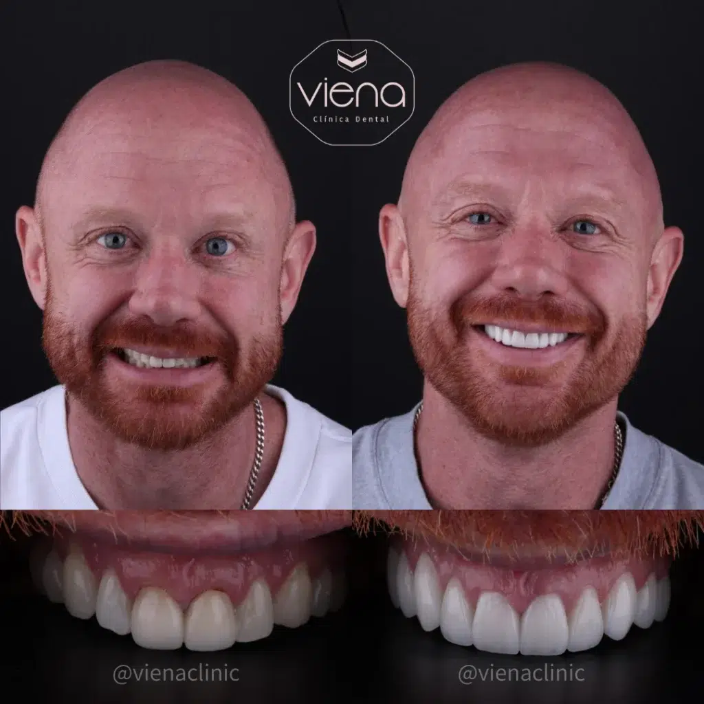 Veneers Gum Recession: Are Veneers An Option For You? Veneers in Colombia – case 1 before and after