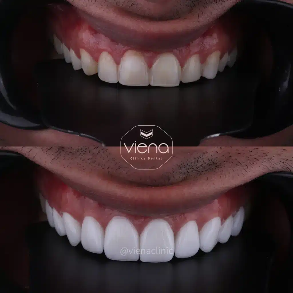 case treated with veneers in Colombia