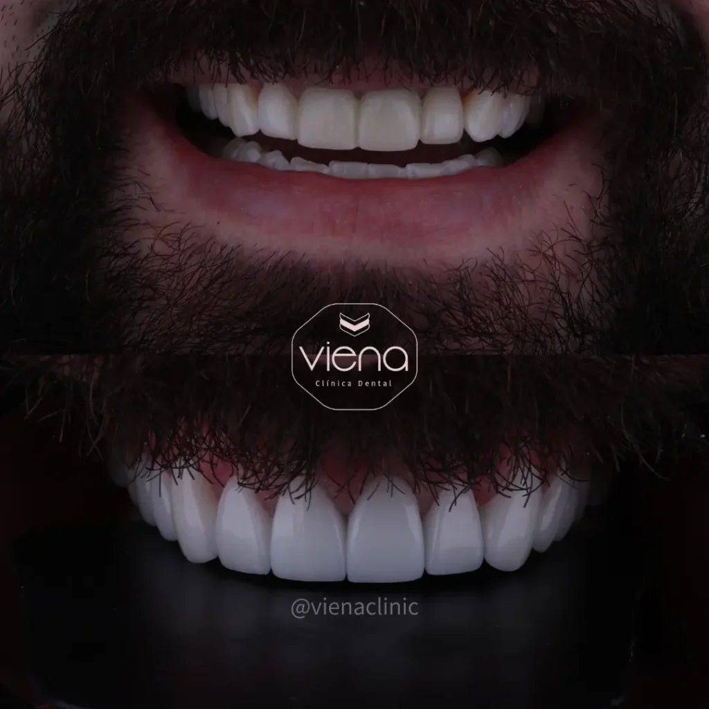 Veneers Gum Recession: Are Veneers An Option For You? Veneers in Colombia Package