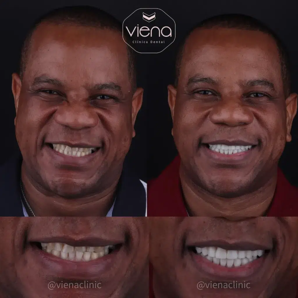 Dental Clinic veneers before and after process