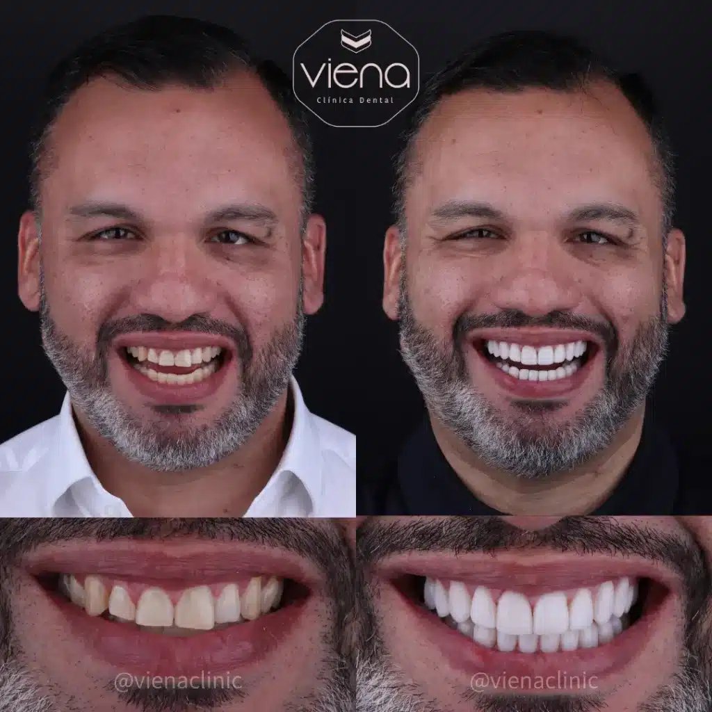 Veneers in colombia