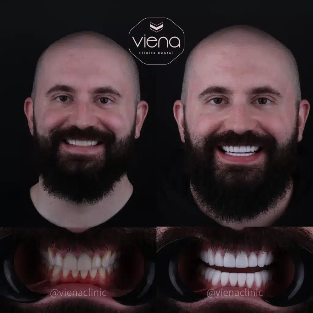 veneers in colombia