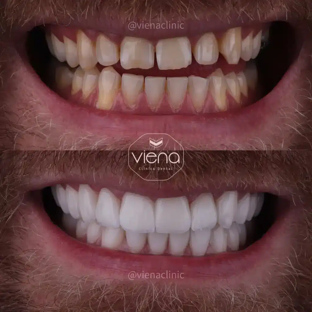 Veneers in colombia