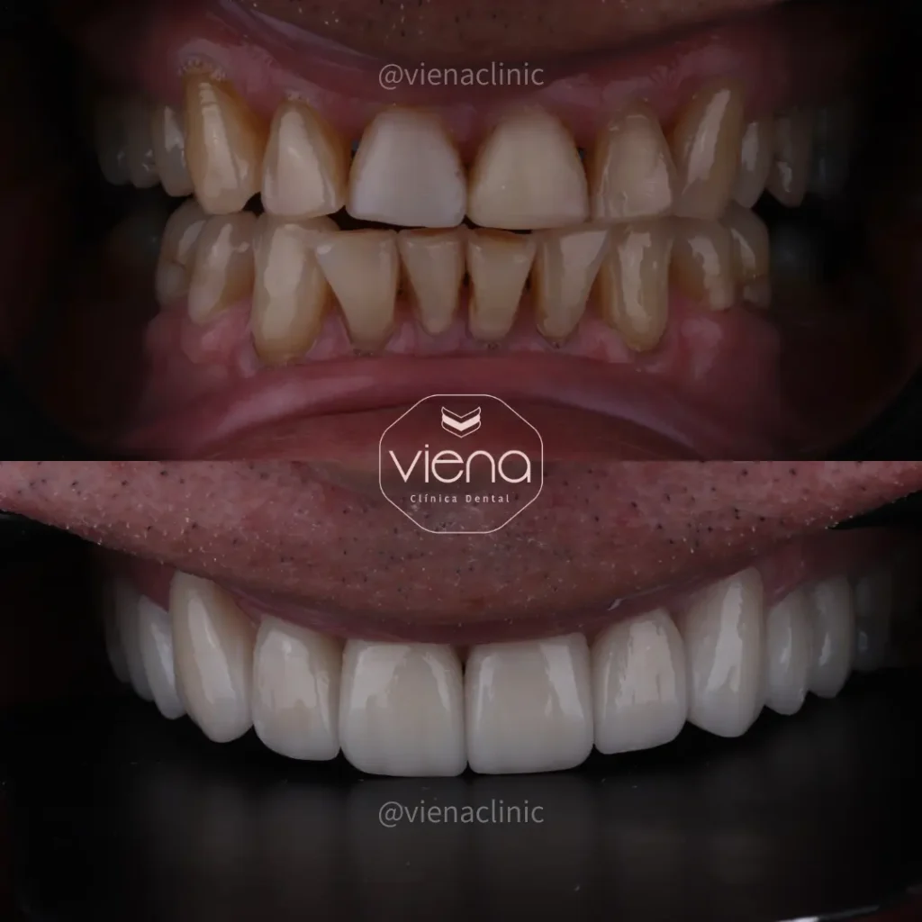 Dental Crowns In Colombia Odontología Medellín