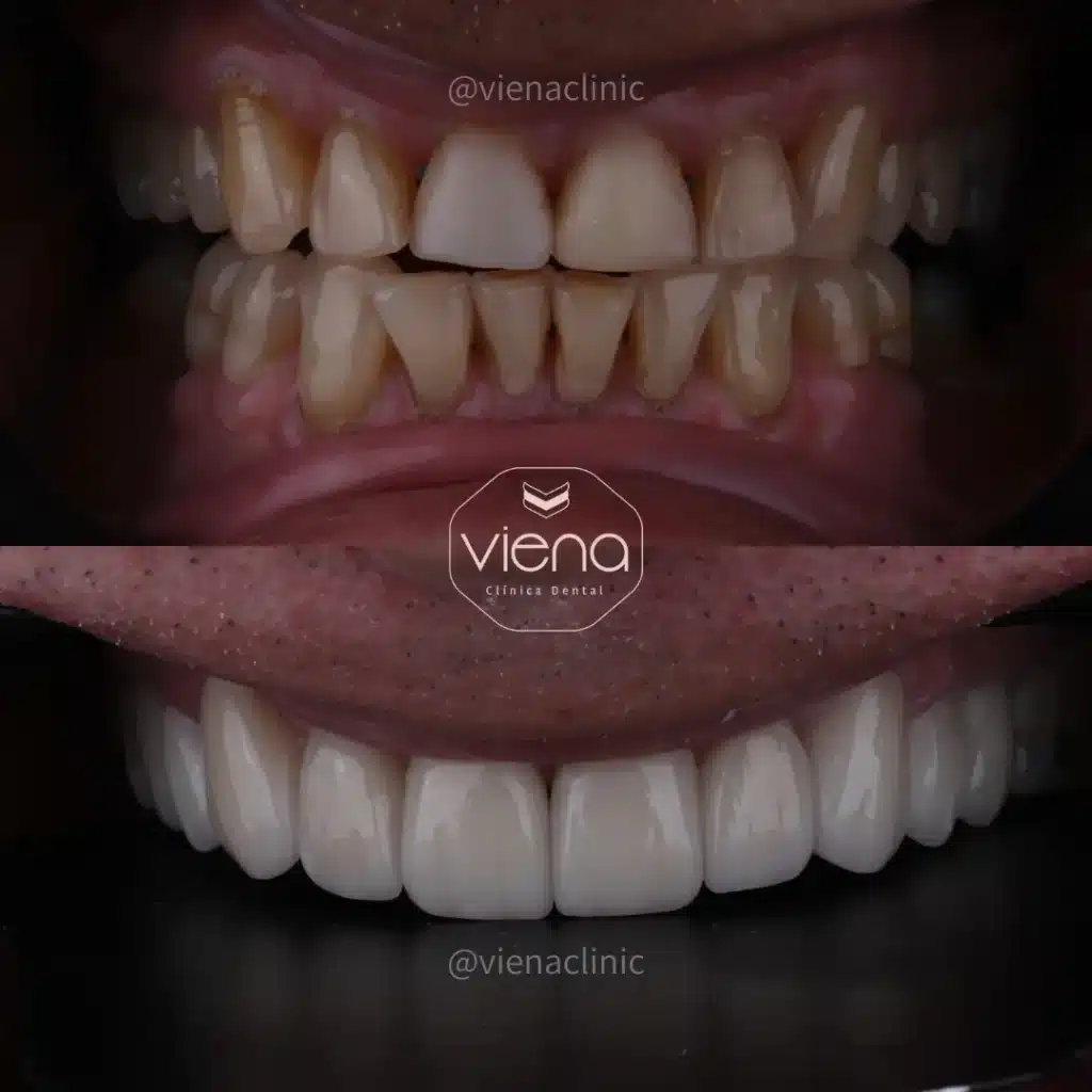 veneers in colombia