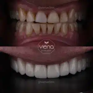 veneers in colombia