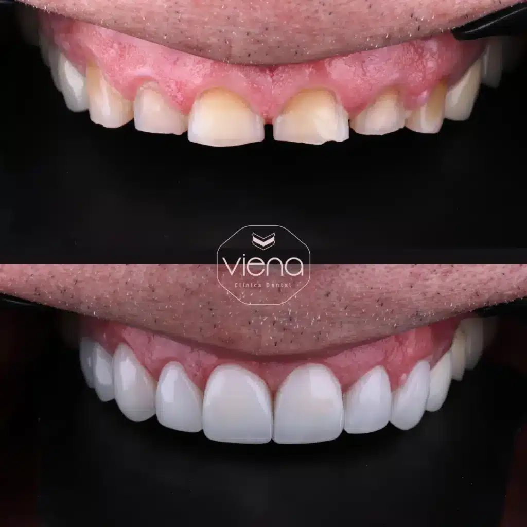 Broken front tooth treated with veneers in Colombia