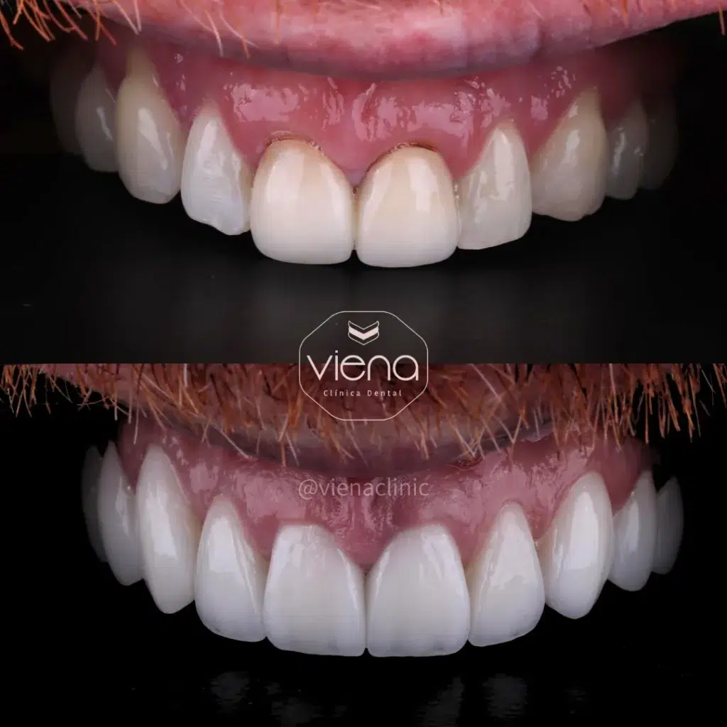Dental Crowns In Colombia coronas dentales