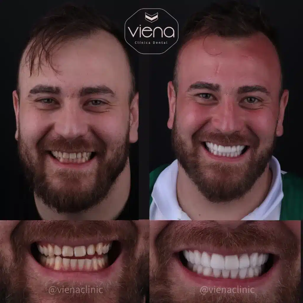 diseño de sonrisa en ceramica