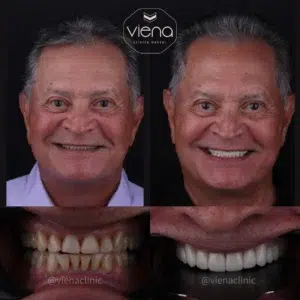 veneers before and after process
