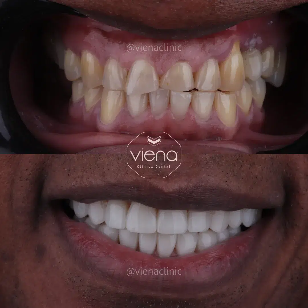 Precio de Carillas Dentales en USA