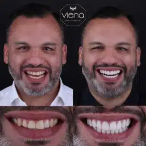 Are veneers permanent - ceramic veneer before and after Clínica Viena Medellín