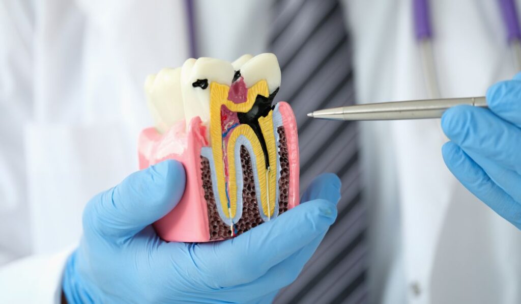 veneers with cavities