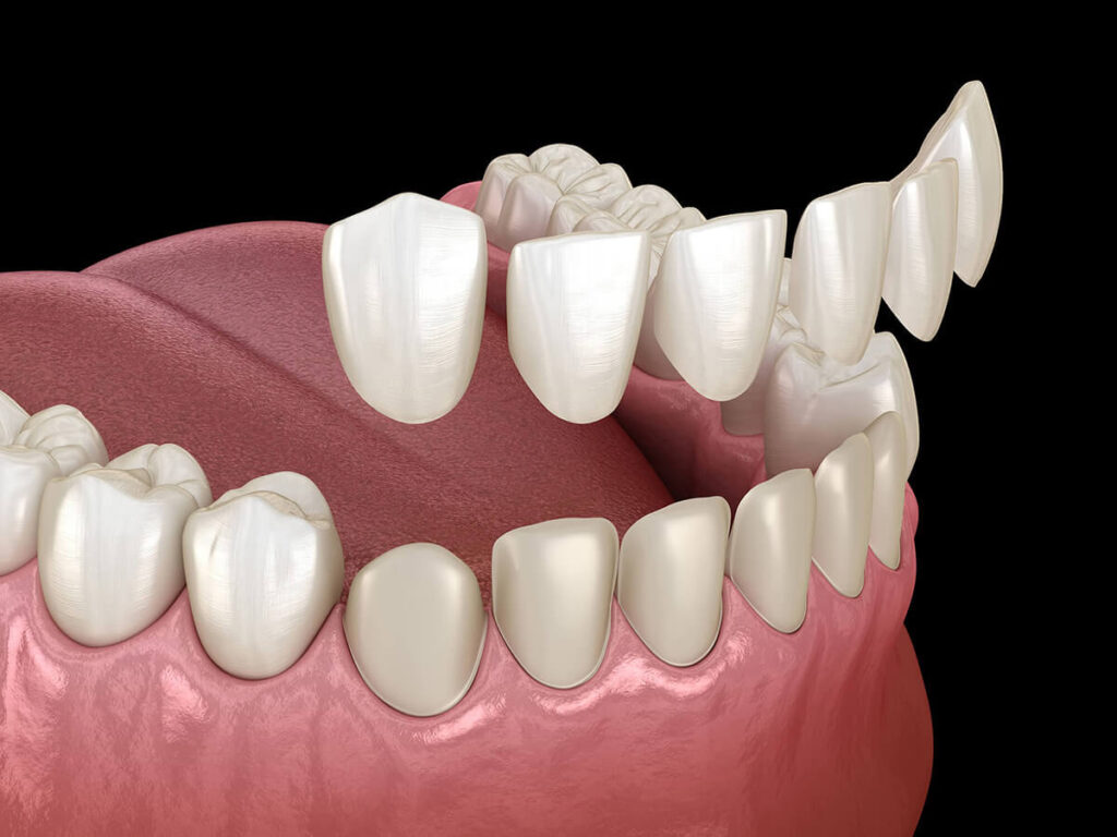 Veneers getting removed