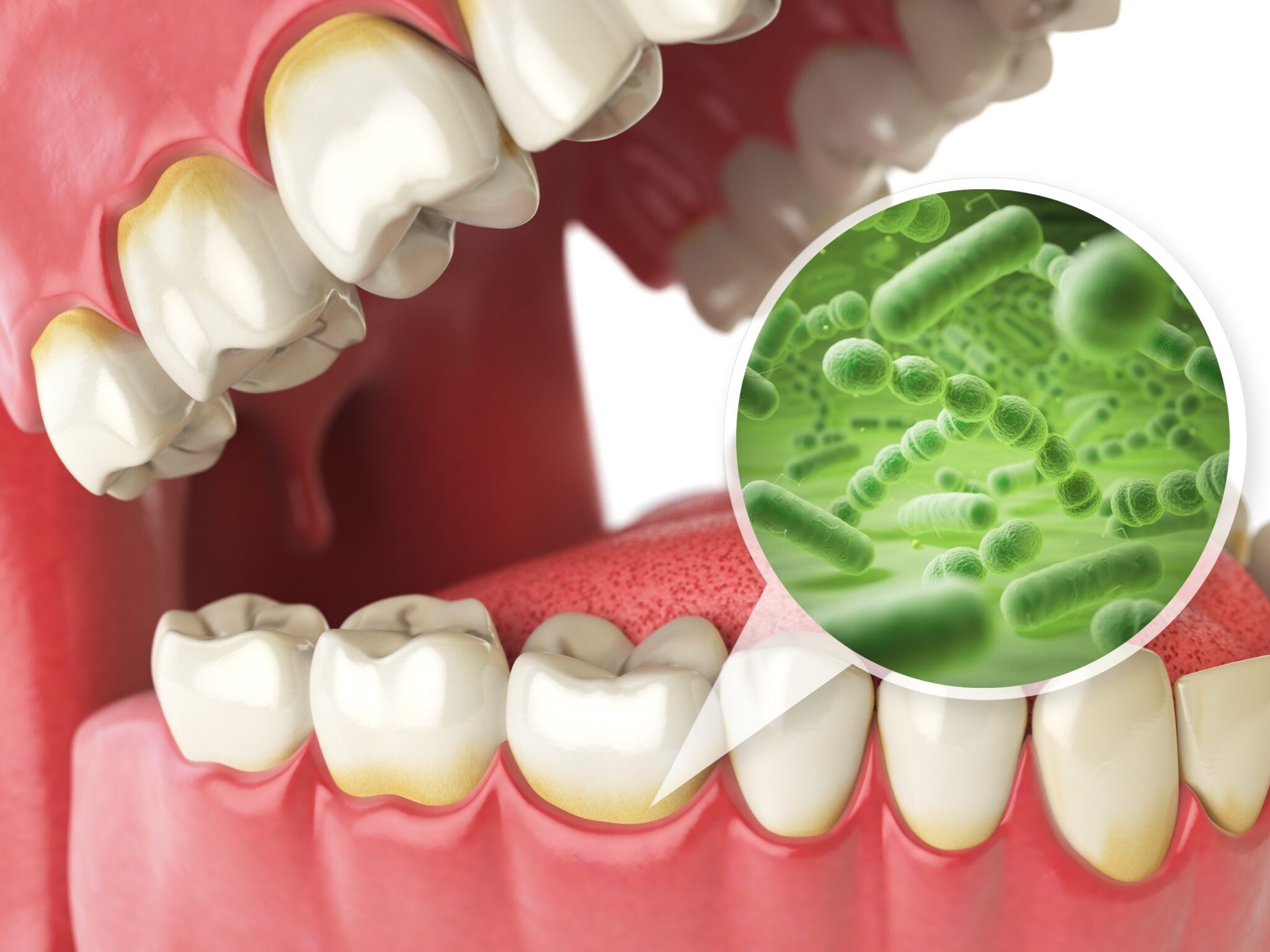 gum disease treated at clinica viena
