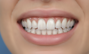 Cuanto dura un diseño de sonrisa en resina Colombia