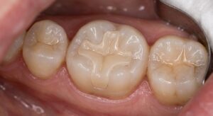 Incrustaciones dentales Clinica viena