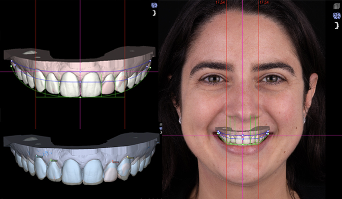 Smile mock-up for veneers clinica viena medellin latam for international patients