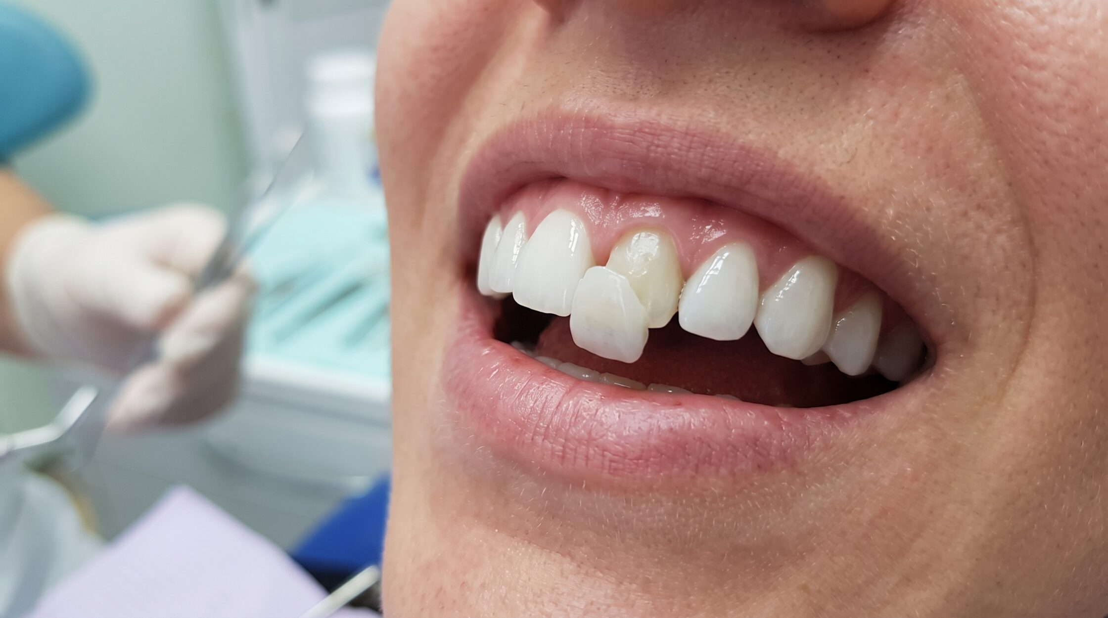 veneer fell off after dental tourism