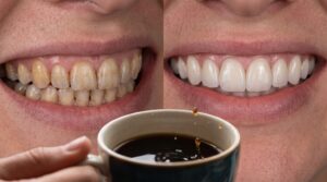 Do veneers Stain? clinica viena Medellin