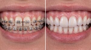 veneers after braces clinica Viena medellin