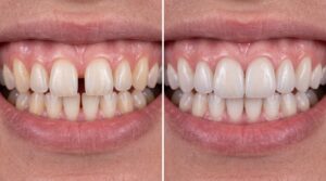 Can veneers fix gap teeth? clinica viena medellin